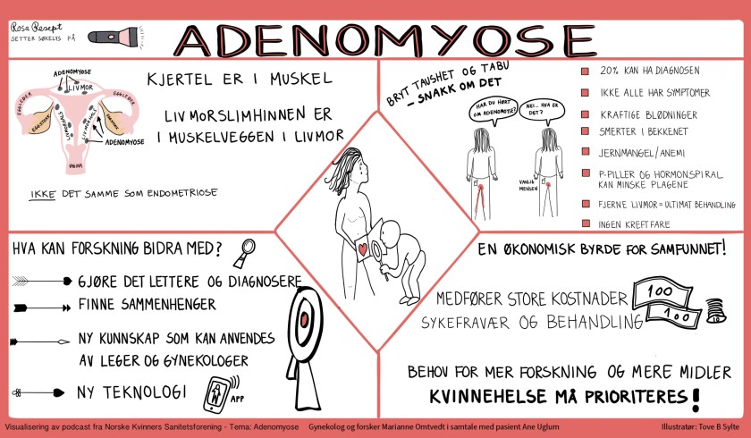 Kvinnesykdom adenomyose 